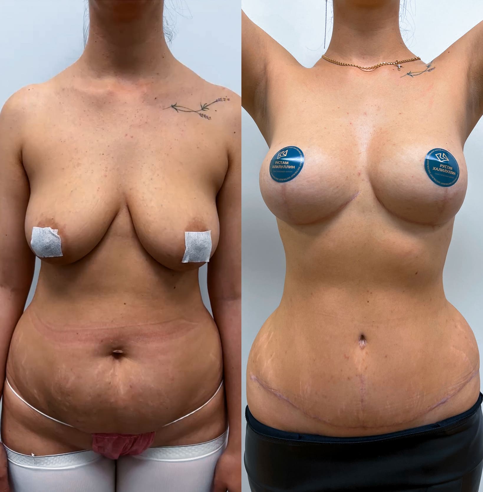 операция по подтяжке груди у женщин фото 11