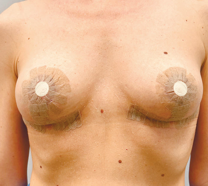 Пример наклеенных стрипов - Хирург Халилуллин Р.И.