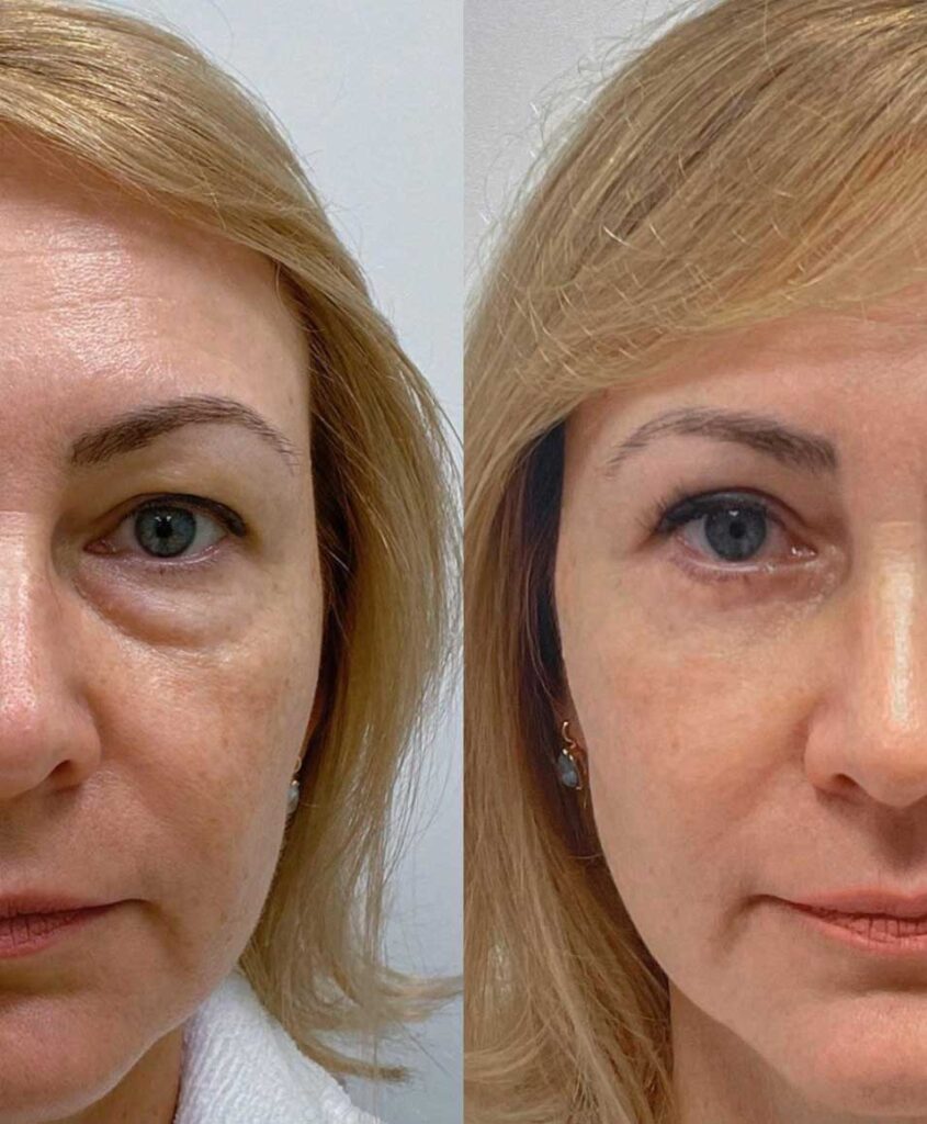 Блефаропластика.