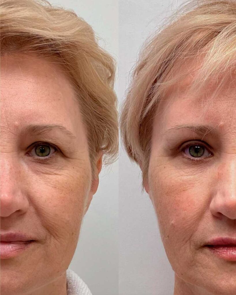 Сочетание блефаропластики и фейслифтинга