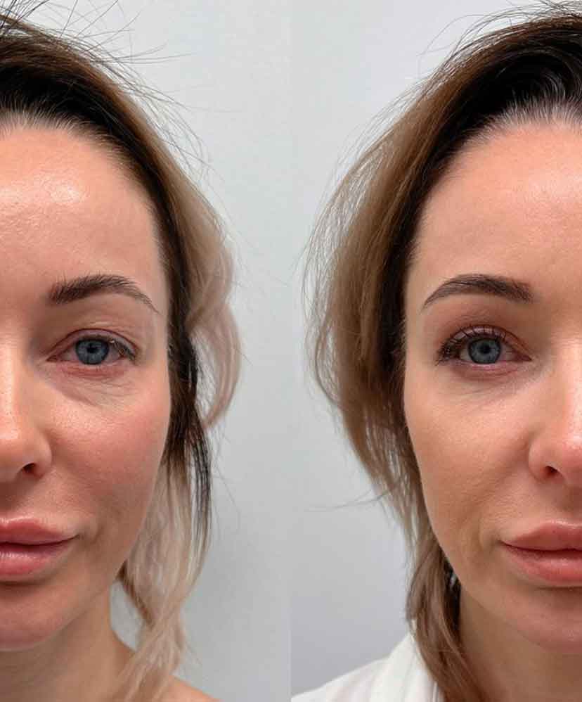 Блефаропластика.