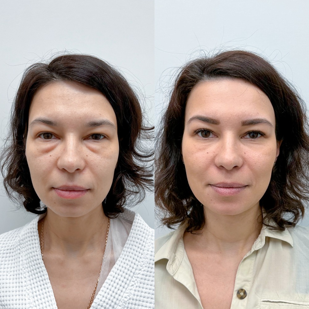 Трансконъюнктивальная блефаропластика.