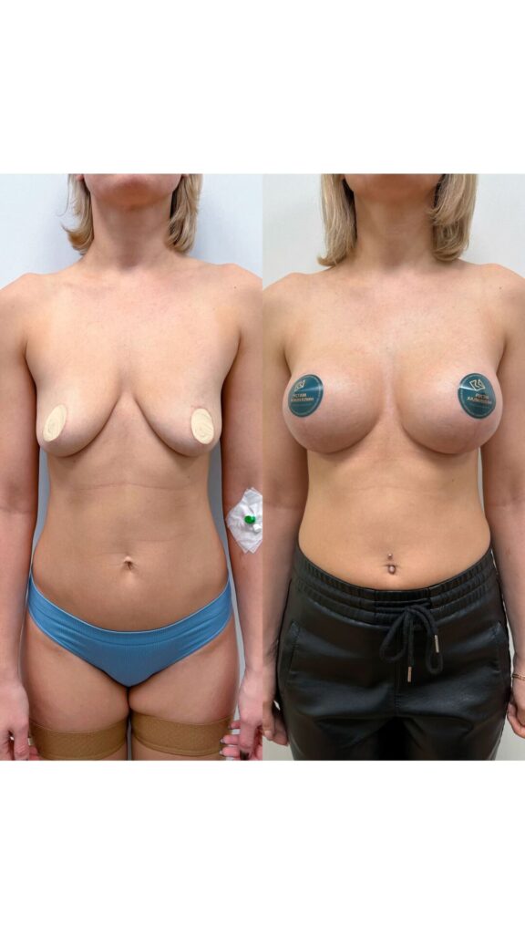 Якорная подтяжка с одномоментной имплантацией.