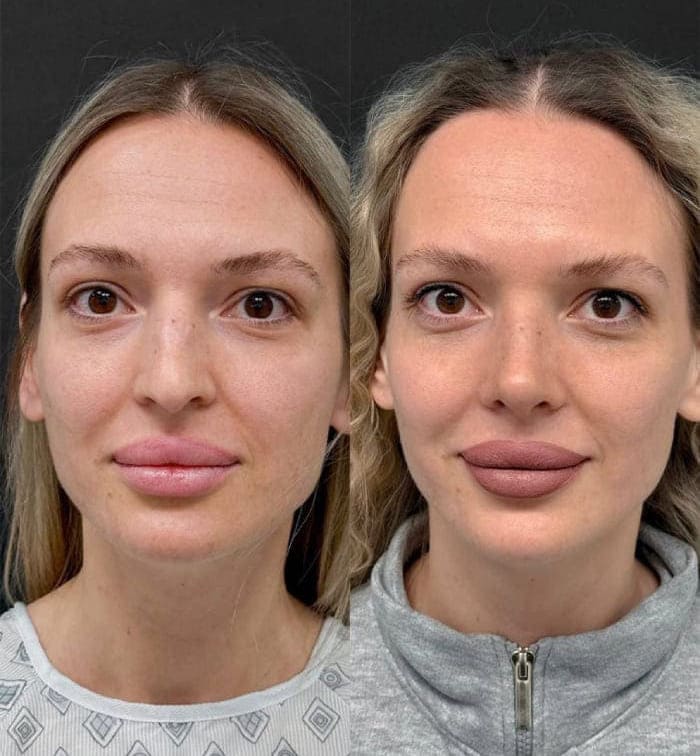 Результаты ринопластики. 2 недели после операции. Халилуллин Р.И.