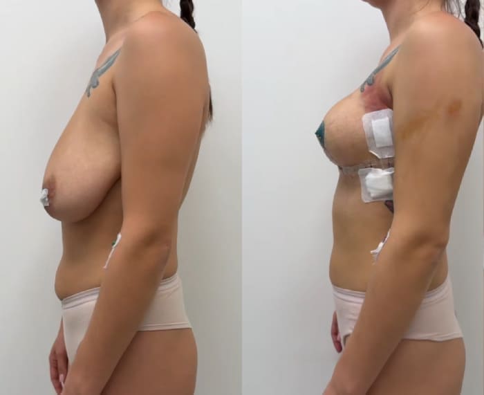 Якорная подтяжка без имплантации. Вид сбоку. Работа пластического хирурга Халилуллина Р.И.