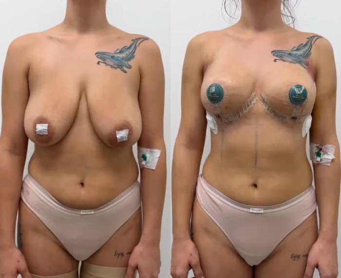 Якорная подтяжка без имплантации. Вид спереди. Работа пластического хирурга Халилуллина Р.И.