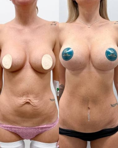 Комплексная операция: Липоабдоминопластика с реэндопротезированием