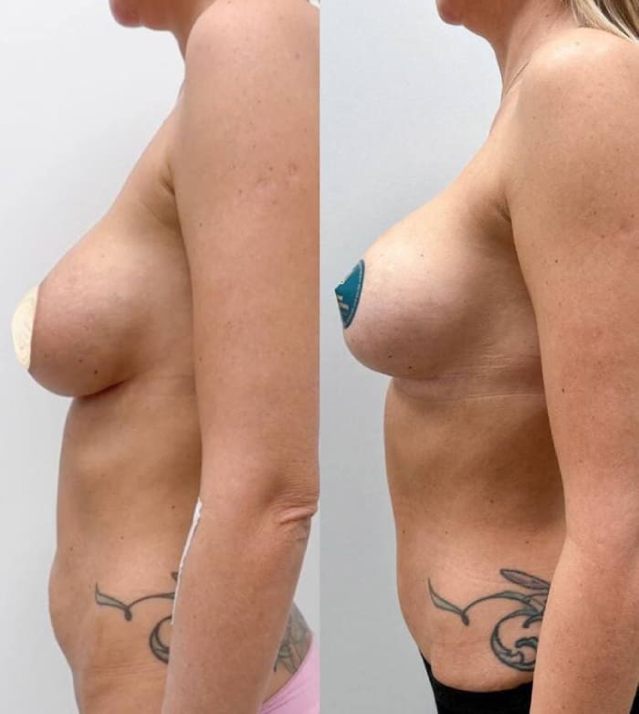 Липоабдоминопластика с реэндопротезированием. Вид сбоку.