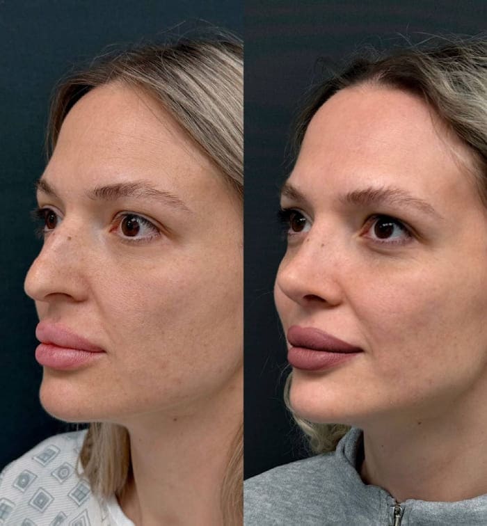 Ринопластика. Динамика 2 недели. Хирург Халилуллин Р.И.