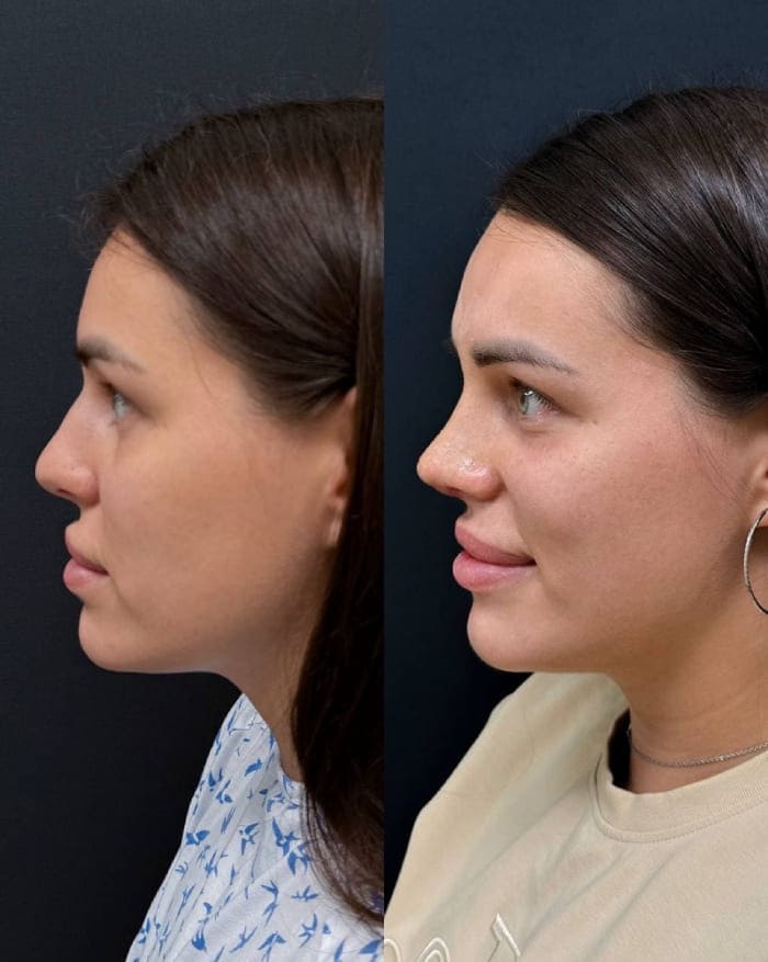 Результат ринопластики. Фото сбоку. Хирург Халилуллин Р.И.