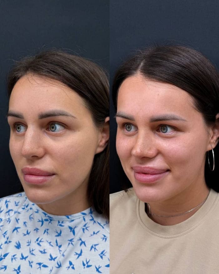 Результат ринопластики у Халилуллина Р.И.