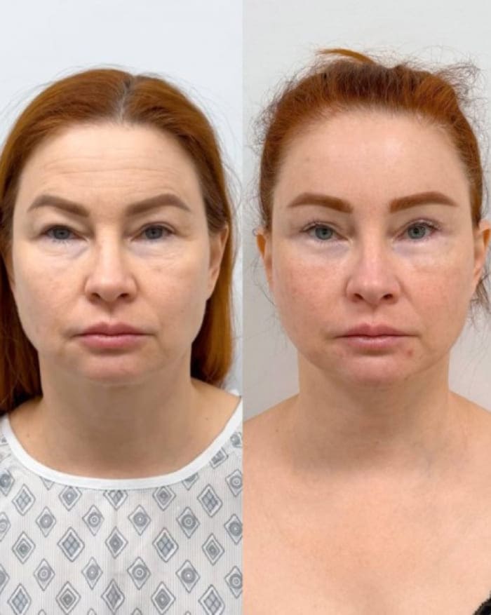 Результаты комплексной операции у пластического хирурга Халилуллина Р.И.