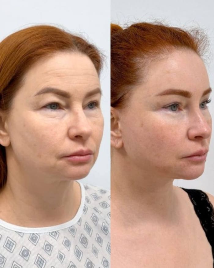 Результаты комплексной операции: блефаропластика, СМАС лифтинг