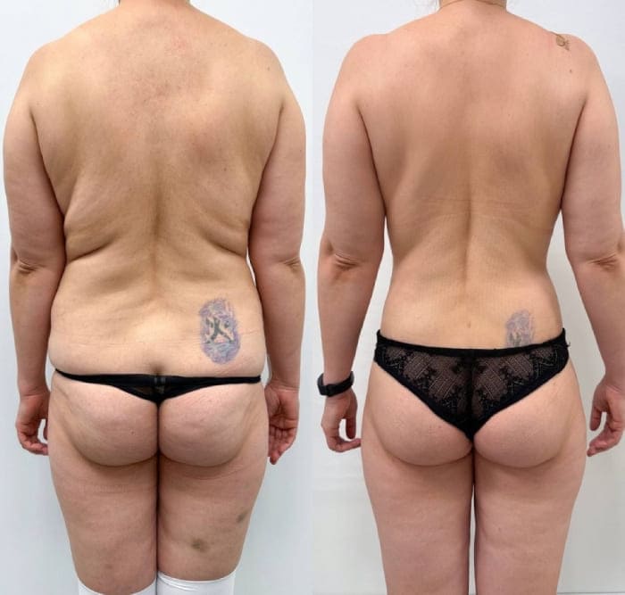 Подтяжка без имплантации и бодилифт. Вид сзади. Хирург Халилуллин р.И.