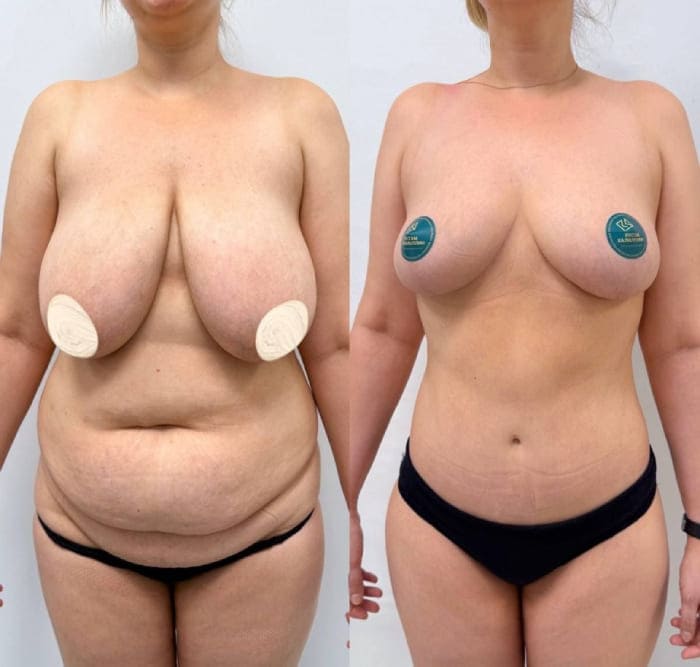 Подтяжка без имплантации и бодилифт. Вид спереди. Хирург Халилуллин Р.И.