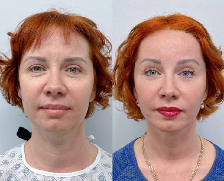 СМАС, эндоскопия, платизмопластика. До и после. Халилуллин Р.И.