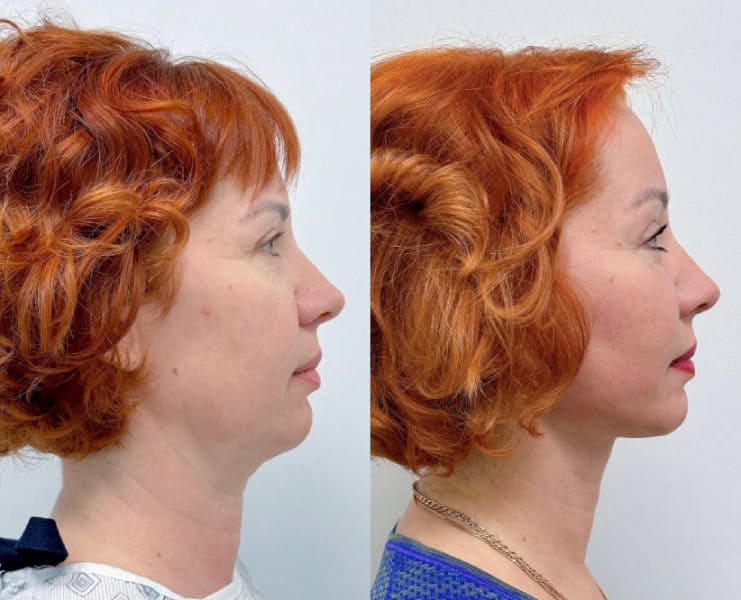 СМАС, эндоскопия, платизмопластика. Вид сбоку. Халилуллин Р.И.