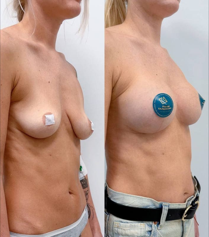 Пример якорной подтяжки с имплантацией. Хирург Халилуллин Р.И.