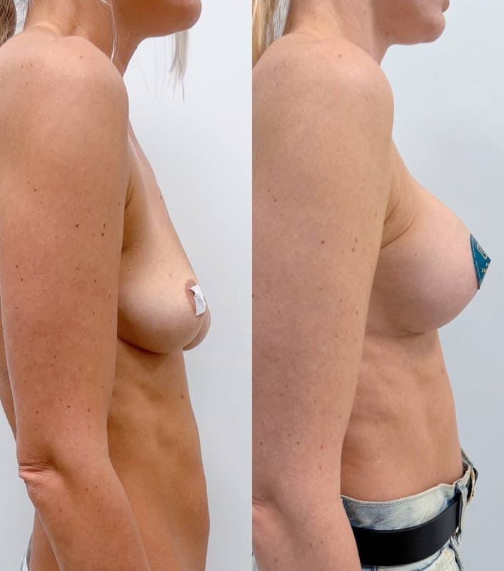 Выполнена якорная подтяжка с имплантацией. Хирург Халилуллин Р.И.