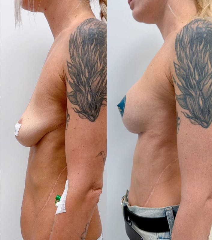 Якорная подтяжка груди с имплантацией. Хирург Халилуллин Р.И. Вид сбоку