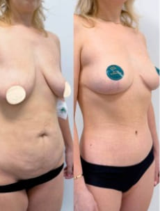 Пример работы хирурга Халилуллина Р.И. Бодилифт, подтяжка груди и феморопластика.