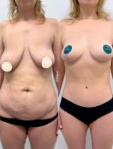 Пример работы Халилуллина Р.И. Бодилифт, подтяжка груди и феморопластика.