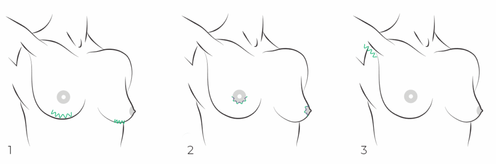 Доступы при маммопластике. Хирург Халилуллин Р.И.