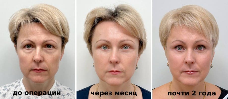 Пример работы эндоскопического лифтинга с блефаропластикой пластического хирурга Рустама Халилуллина