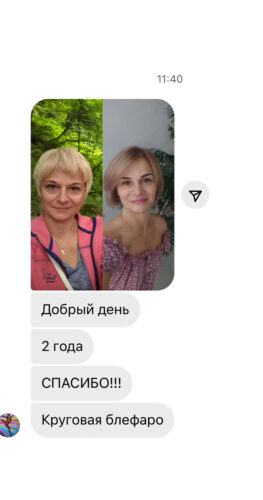 Расширенная блефаропластика