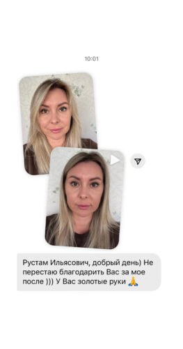 Расширенная блефаропластика