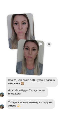 Расширенная блефаропластика