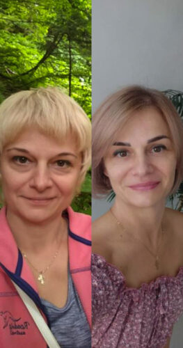 Круговая блефаропластика