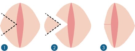Иллюстрация лабиопластики рис.2