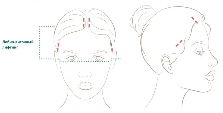 Лобно-височный лифтинг - схема разрезов. Хирург Халилуллин Р.И.