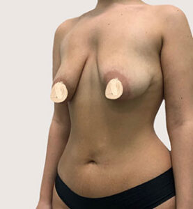 Увеличение груди с якорной подтяжкой - до