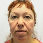 Круговая блефаропластика - до