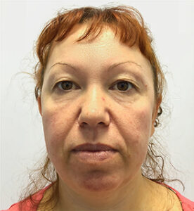 Круговая блефаропластика - до