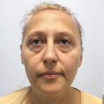 Круговая блефаропластика - до