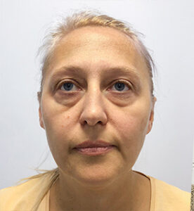 Круговая блефаропластика - до