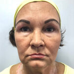 Круговая блефаропластика - до