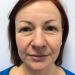 Круговая блефаропластика - до