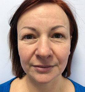 Круговая блефаропластика - до