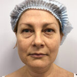 Круговая блефаропластика - до