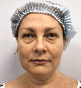 Круговая блефаропластика - до