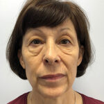 Круговая блефаропластика - до