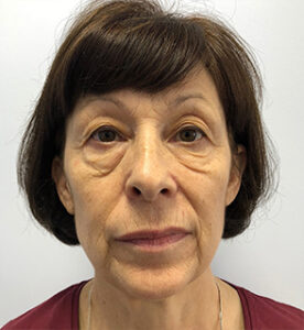 Круговая блефаропластика - до