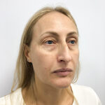 Круговая блефаропластика - до