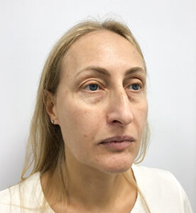 Круговая блефаропластика - до