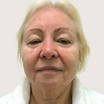 Круговая блефаропластика - до