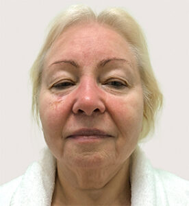 Круговая блефаропластика - до